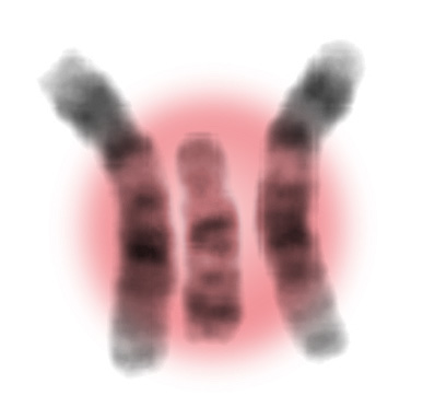 chromosome triplet with the extra highlighted