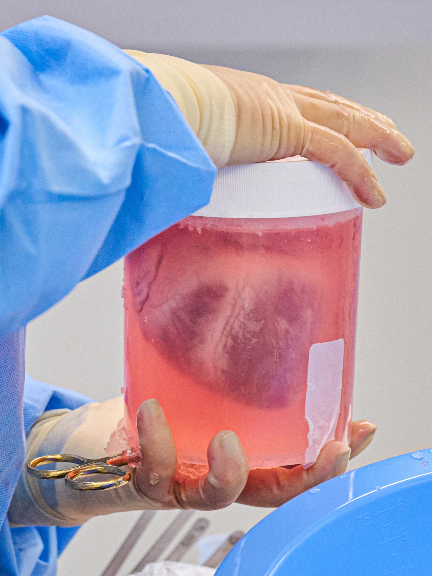 doctor's gloved hands holding a jar containing a heart